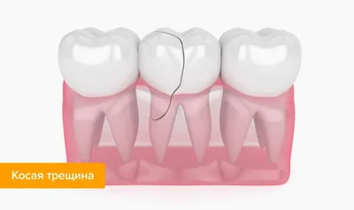 ᐈ Перелом зуба: причины, виды, симптомы, лечение