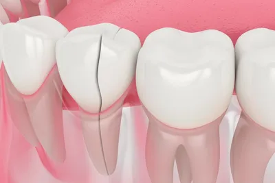 Перелом зуба: симптомы, диагностика и лечение — клиника Доктора Федорова