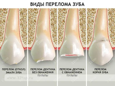 Перелом зуба: перелом корня зуба, перелом коронки зуба, у детей, лечение,  симптомы