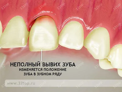 Перелом зуба: перелом корня зуба, перелом коронки зуба, у детей, лечение,  симптомы