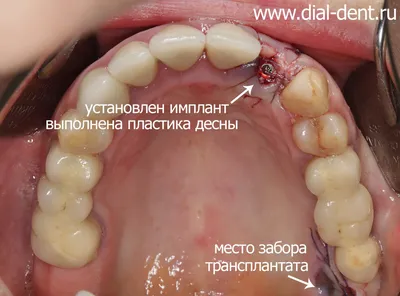 Перелом переднего зуба и одномоментная имплантация