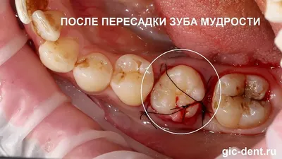 Трещина корня зуба: как появляется, виды, симптоматика, лечение - Немецкий  имплантологический центр, Москва