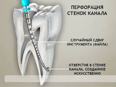 Лечение перфорации корня зуба