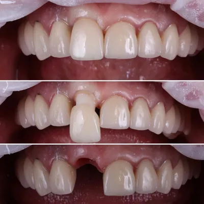 Перелом корня зуба: поможет только имплантация! - Стоматологическая клиника  Лазурит