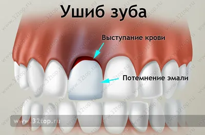 Травмы Зубов-Ушиб Зуба,Трещина Коронки, Перелом Коронки Зуба