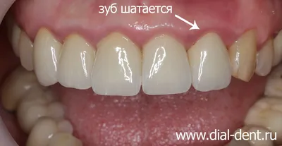 Перелом переднего зуба и одномоментная имплантация