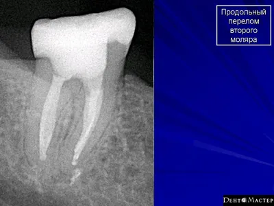 Стоматология. Травма. Переломы. Переломы зубов. + | Портал радиологов