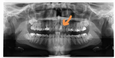 Нужна Ваша консультация (снимок ОПТГ) - Стоматология - Форум стоматологов  (стомотологический форум) - Профессиональный стоматологический портал  (сайт) «Клуб стоматологов»