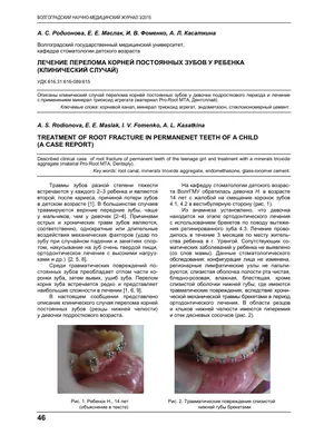 Лечение перелома корней постоянных зубов у ребенка (клинический случай) –  тема научной статьи по клинической медицине читайте бесплатно текст  научно-исследовательской работы в электронной библиотеке КиберЛенинка