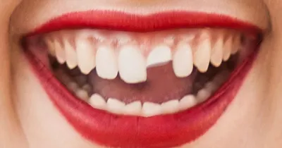 Перелом зуба [продольный, вертикальный, полный, симптомы и лечение]