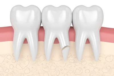 Перелом зуба: симптомы, диагностика и лечение — клиника Доктора Федорова