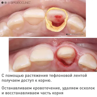 ПЕРЕЛОМ КОРНЯ | Спасибо.Клиник | Дзен