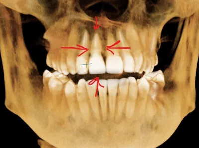 Перелом корня, кость с бугра, имплантация с шаблоном, скан-маркер и  лабораторная коронка. Всё ради одного зуба | Пикабу