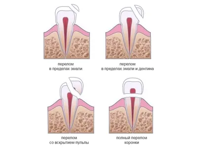 Перелом зуба