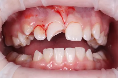 Механические травмы зуба - ВилмаДент