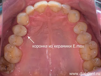 Трещина в зубе