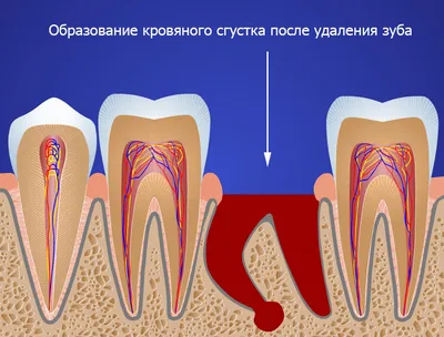 Удаление корня зуба