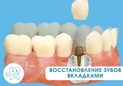 Протезирование зубов - восстановление зубов вкладками | Стоматология Улыбка