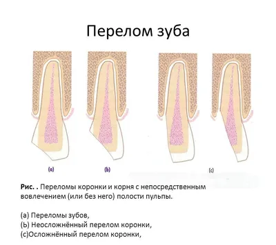 Перелом зуба - DentaGuard