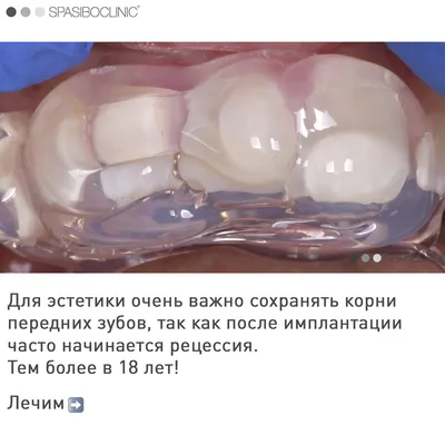 Перелом корня зуба.... - Korean Dental Clinic - Tashkent, UZ | Facebook