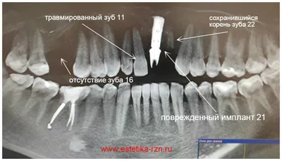 Перелом зуба | Стоматология Митино
