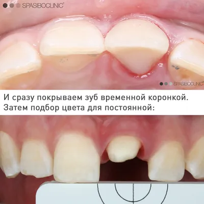 Перфорация зуба: симптомы, диагностика и лечение в стоматологической клинике