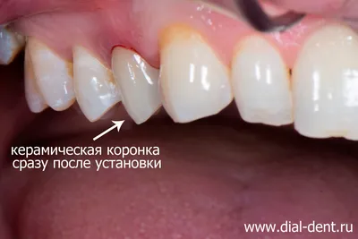 Имплантация в области фронтальных и боковых зубов (восстановление после  травмы - Эстетика