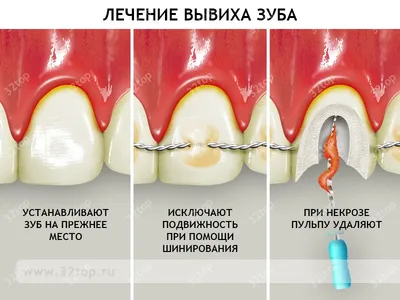 Трещина в зубе