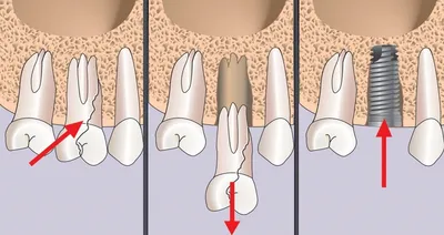 Резекция верхушки корня зуба у Dr.Полетаева А.Л.