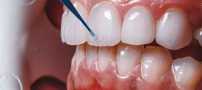 Одномоментная имплантация после перелома корня зуба :: NORD DENTAL — сеть  клиник семейной стоматологии на севере Петербурга