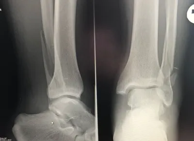 Перелом лодыжки | Фото до и после, операция, отзывы, лечение, реабилитация  и восстановление