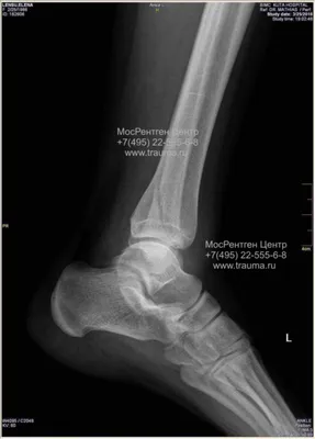 Как выглядит перелом наружной лодыжки на рентгене