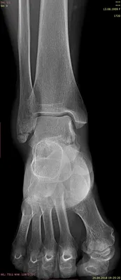 Перелом латеральной лодыжки | Портал радиологов