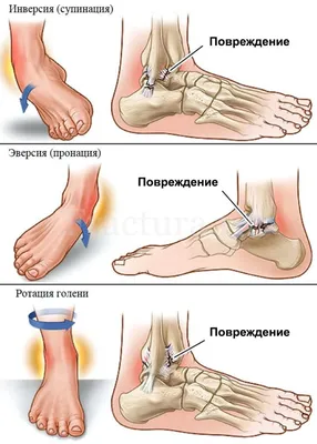 Перелом лодыжек – Fractura.ru