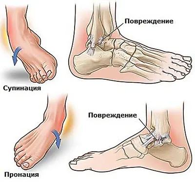 ПЕРЕЛОМ ЛОДЫЖЕК | СПОРТИВНАЯ ТРАВМАТОЛОГИЯ