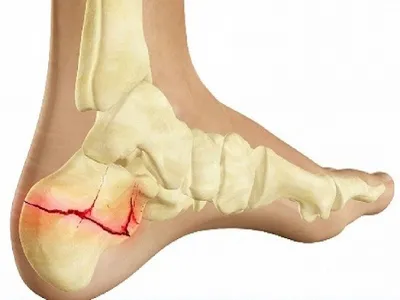 Перелом пяточной кости, лечение и реабилитация в Москве