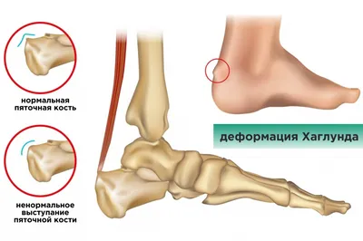 Рентгенография пяточной кости