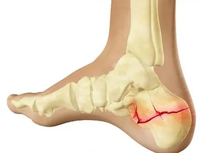 Перелом пяточной кости - признаки, причины, симптомы, лечение и  профилактика - iDoctor.kz