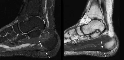 Перелом плюсневой кости | Фото до и после, операция, отзывы, лечение,  реабилитация и восстановление
