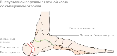 Перелом пятки: со смещением и без, симптомы, лечение, сколько заживает,  реабилитация