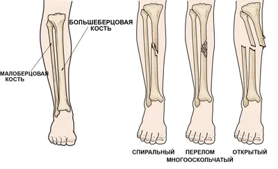 Эпифизеолиз — Википедия