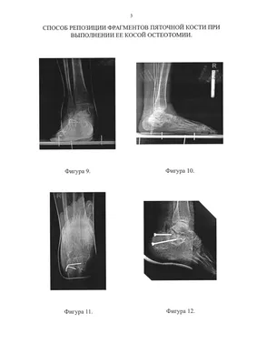 Переломы фаланг пальцев — симптомы, диагностика, лечение в НКЦ№2 (ЦКБ РАН)