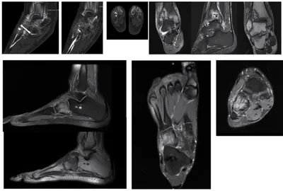 Closed Fractures of the Distal Part of the Shin Bones. Different Types and  Methods of the Treatment in Adolescence. Short Period Results - Dorokhin -  Physical and rehabilitation medicine, medical rehabilitation