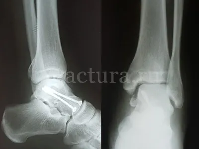 Closed Fractures of the Distal Part of the Shin Bones. Different Types and  Methods of the Treatment in Adolescence. Short Period Results - Dorokhin -  Physical and rehabilitation medicine, medical rehabilitation