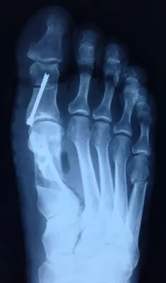 Рентгеноморфологические показатели костей стопы при лечении перело