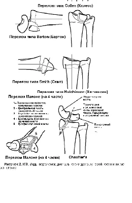 Перелом дистального метаэпифиза лучевой кости (перелом лучевой кости «в  типичном месте») — симптомы, диагностика, лечение в НКЦ№2 (ЦКБ РАН)