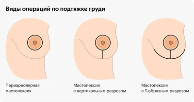 Подтяжка груди по ареоле в Москве | Цены на периареолярную мастопексию