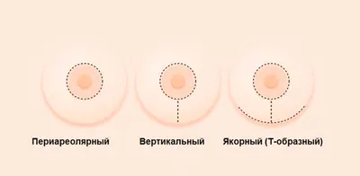 Подтяжка груди: отзыв, фото до и после, цена, как она проходит и какой у  нее эффект