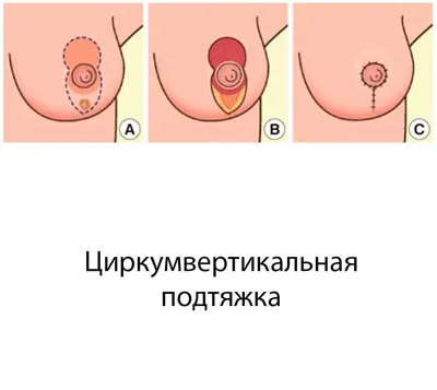 Подтяжка груди. Реэндопротезирование груди с подтяжкой