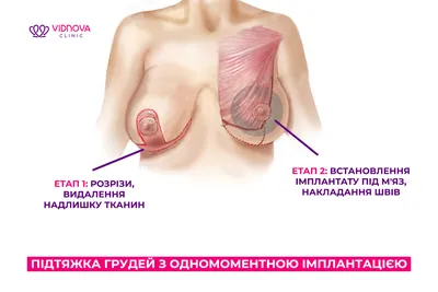 Периареолярная мастопексия: показания и особенности - YouTube